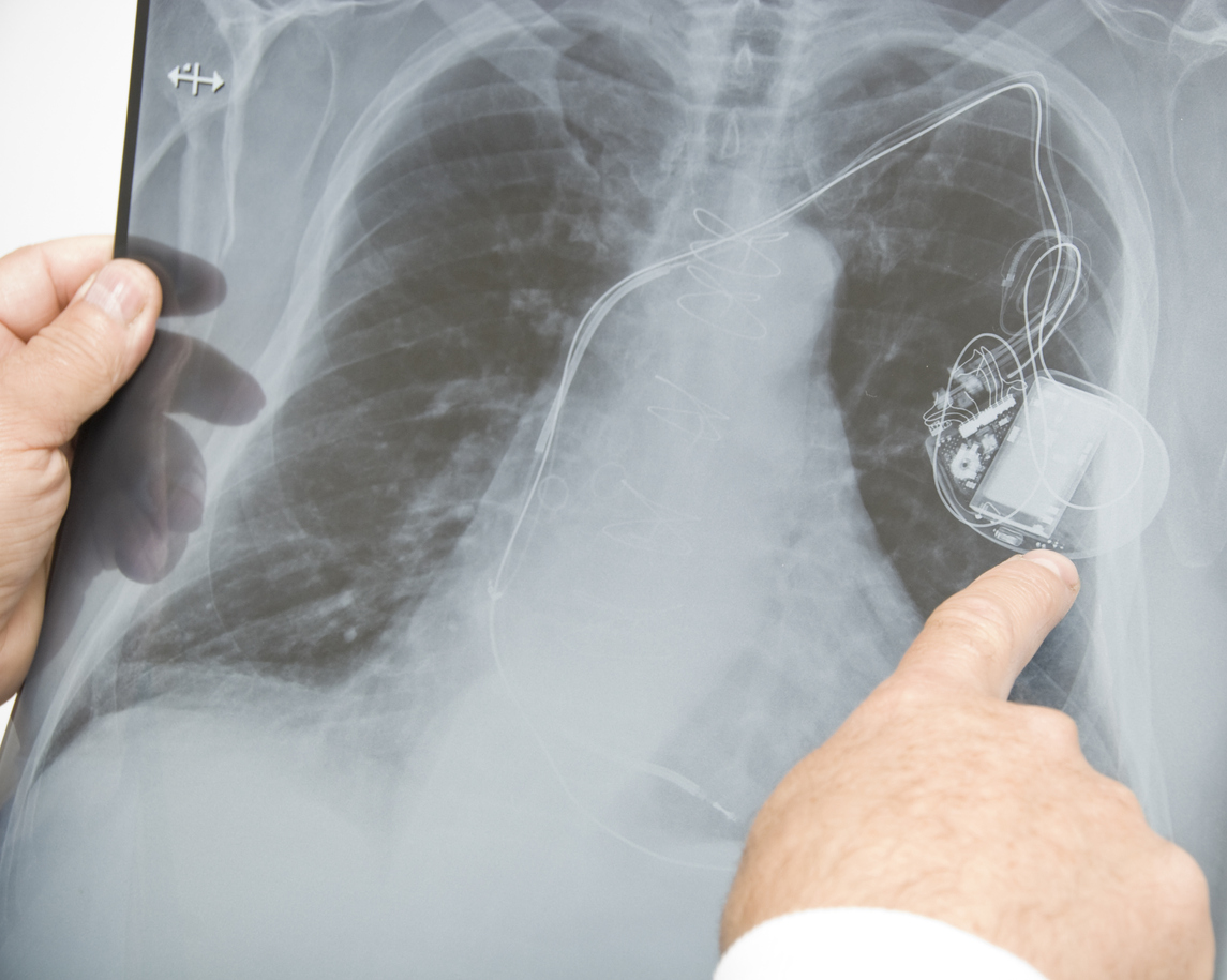 Doctor Examining Human Lungs and Pacemaker